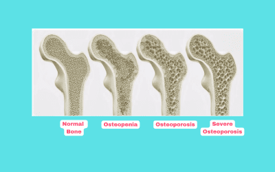 From Fragile to Resilient: A Step-by-Step Approach to Effectively Manage Osteoporosis